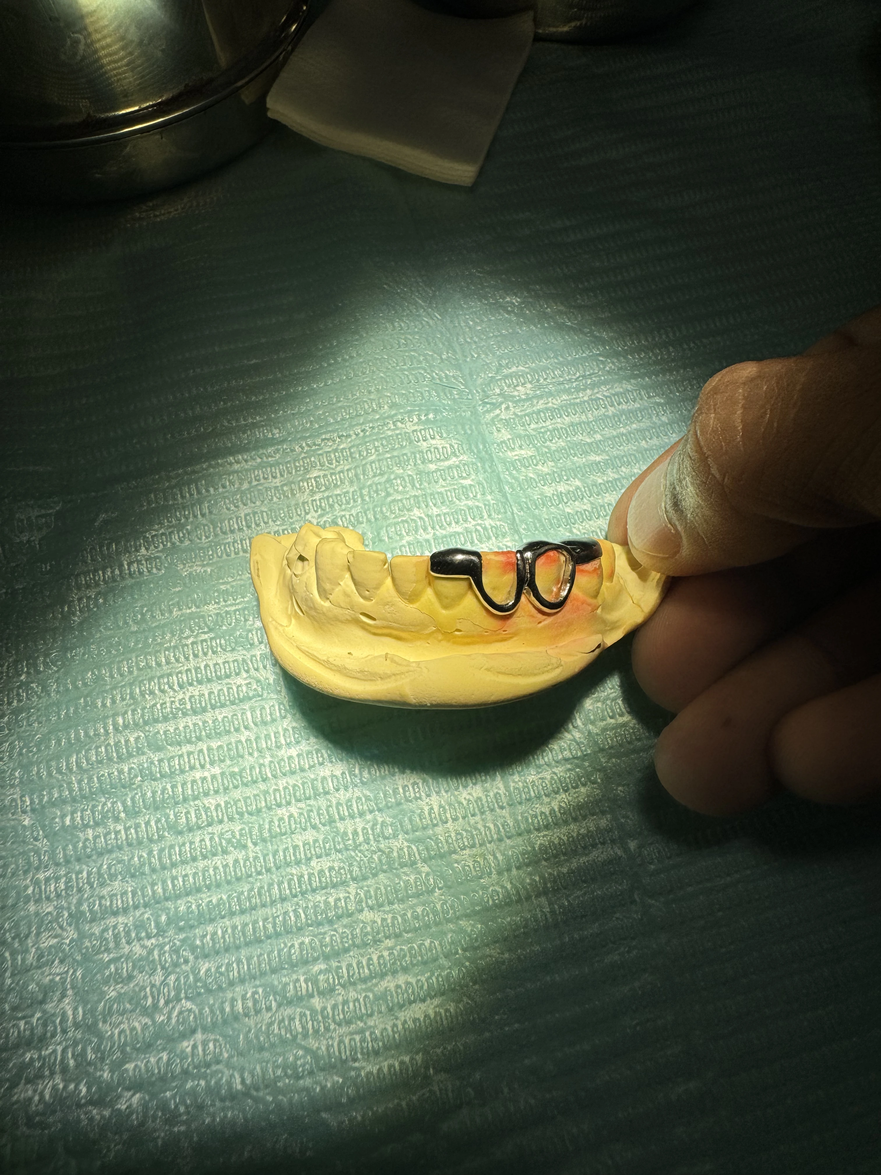 Costume Line Grillz on button Custom Fit in Phnom Penh Cambodia