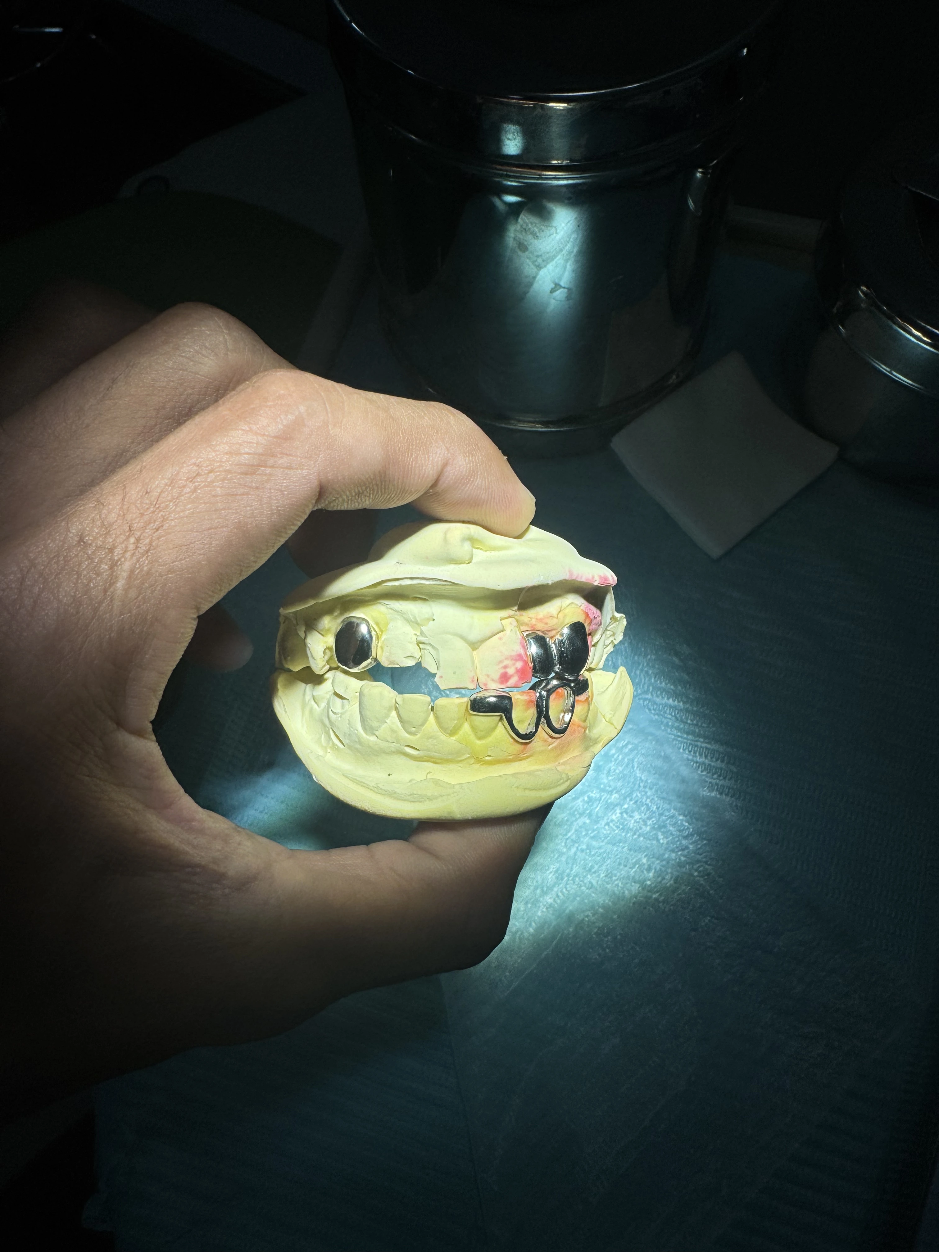 Full couple grillz Custom Connection Set in Phnom Penh Cambodia