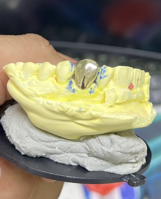 Full cap grillz in Phnom Penh Cambodia